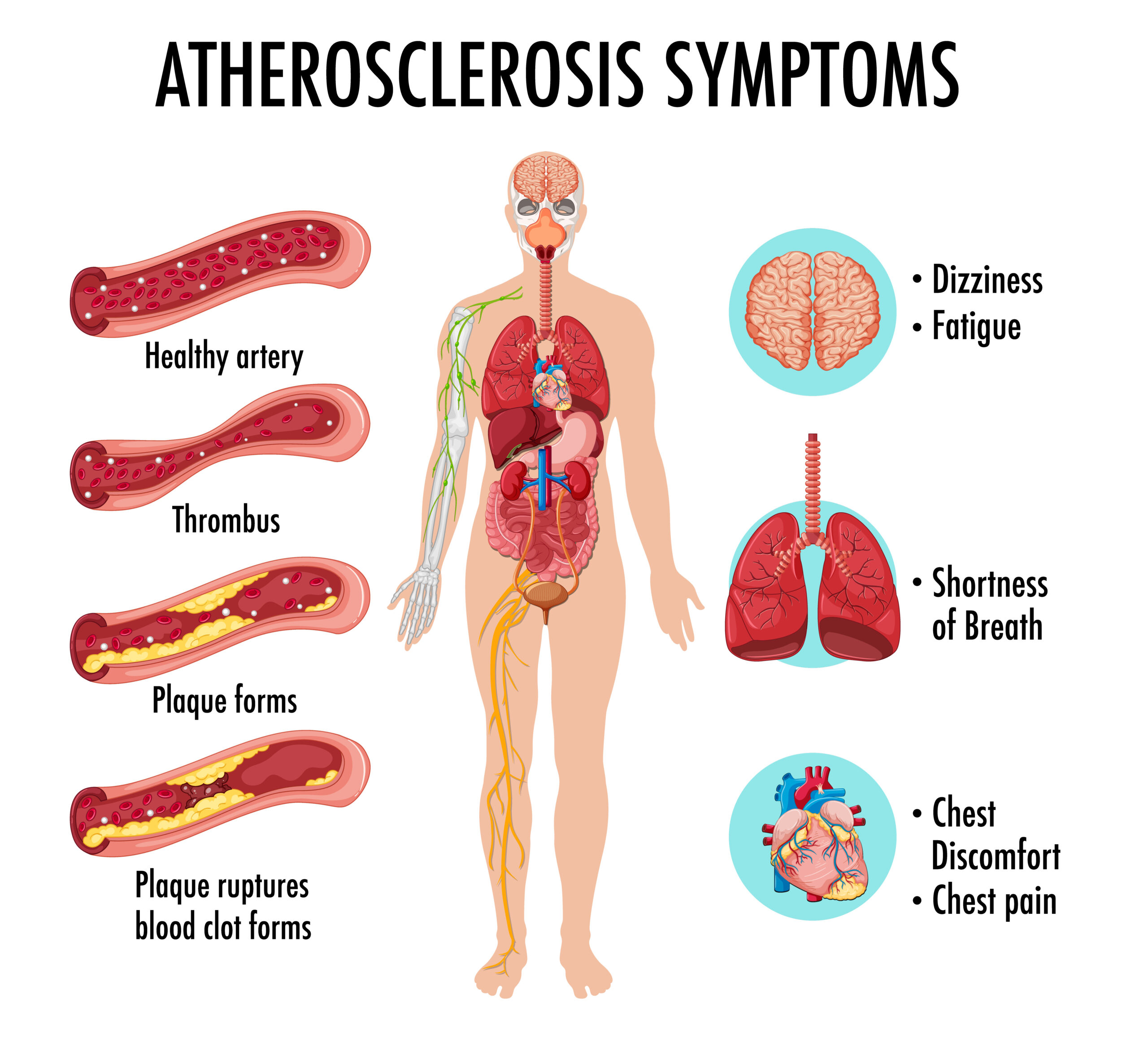 Stages of atherosclerosis information infographic illustration