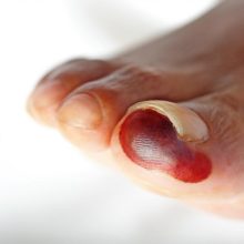 Treatment For Gangerne Of Feet, Hands